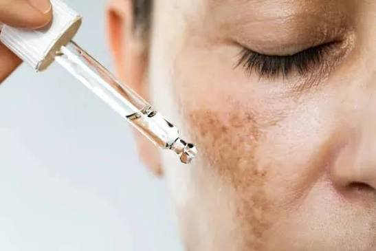 Facial Hyperpigmentation, Skin and Scarring Care at Klinik Vistara Healthcare, Klang